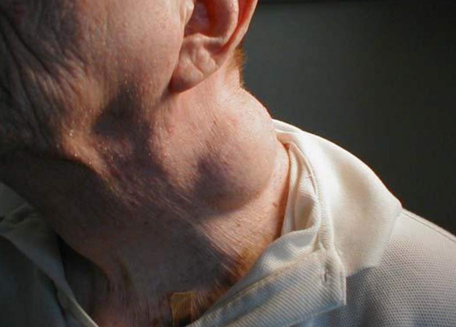 脂肪瘤最新,脂肪瘤的最新研究与治疗进展,脂肪瘤的最新研究与治疗进展概览