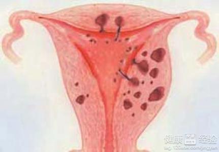 子宫腺肌症最新治疗方法,子宫腺肌症最新治疗方法,照亮女性健康的希望之光,子宫腺肌症最新治疗方法,为女性健康带来希望之光