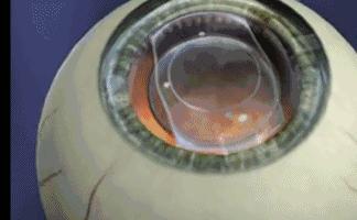 爱尔眼科最新消息,爱尔眼科,引领眼科医疗新篇章的最新消息,爱尔眼科引领眼科医疗新篇章,最新消息速递